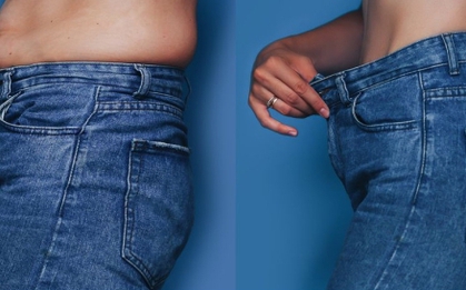 Phẫu thuật ‘nắn’ xương sườn giúp cô gái gen Z có vòng eo con kiến, giảm 15cm