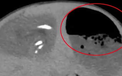 Bụng bé gái sưng to bất thường, bác sĩ phát hiện ra "bí mật" đáng sợ