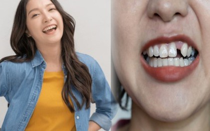Trồng răng Implant: Đầu tư một lần, hiệu quả trọn đời, nâng cao chất lượng cuộc sống