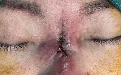 Người phụ nữ bị “ăn thủng mũi” sau khi làm đẹp đổi vận