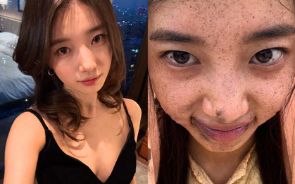 Hình ảnh gây sốc của Suzy trước khi phẫu thuật