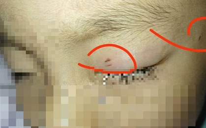 Cậu bé bị nhiễm trùng, mù một bên mắt vì hành động của giáo viên