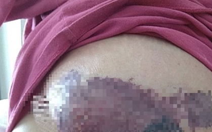 Người phụ nữ mới sinh ngực đột ngột chuyển màu đen, bác sĩ sốc nặng khi phát hiện "bí mật" đáng sợ