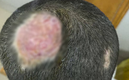 Cậu bé 6 tuổi hói vĩnh viễn vì nuôi thú cưng