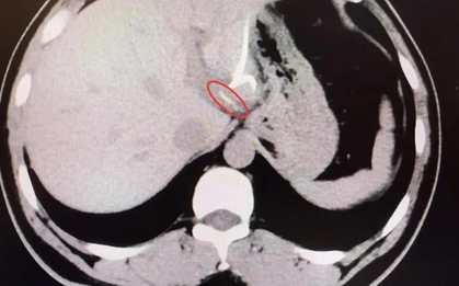 Người đàn ông 37 tuổi suýt mất nửa lá gan vì ăn cá