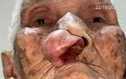 Phẫu thuật cho cụ bà gần 100 tuổi sau 30 năm sống chung với khối u trên mặt