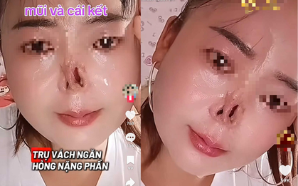 Đi sửa mũi cho thêm xinh, cô gái không ngờ mất luôn sống mũi: BS khuyến cáo 5 việc cần nhớ trước khi nâng mũi để tránh gặp họa