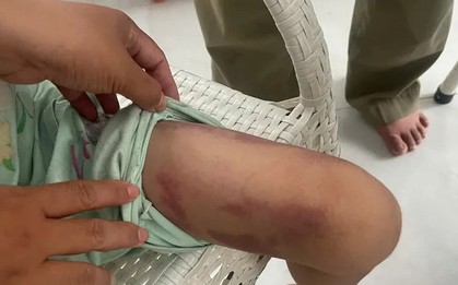 Bé gái 9 tuổi bị mẹ ruột cùng người tình đánh dã man trong phòng trọ