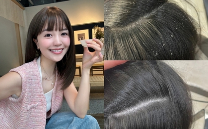 5 dầu gội đặc trị gàu, làm sạch sâu tận chân mà không gây khô tóc