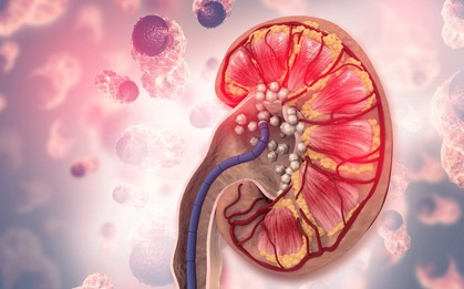 Người có axit uric máu cao thường có 3 đặc điểm này khi ăn uống: Có 1 cũng khiến thận sớm suy hỏng