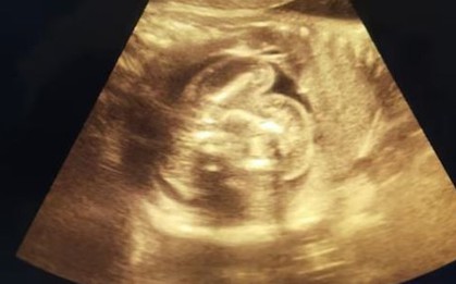 Bác sĩ sốc nặng khi phát hiện bé trai vừa chào đời đã "mang thai"