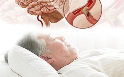 Cảnh báo nguy cơ đột tử do ngủ ngáy kéo dài