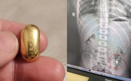 Con trai nuốt miếng vàng của mẹ vào bụng và cái kết