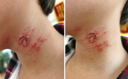 Bé trai 10 tuổi bỗng xuất hiện những nốt mẩn lạ trên da nhưng vẫn chưa tìm ra được nguyên nhân
