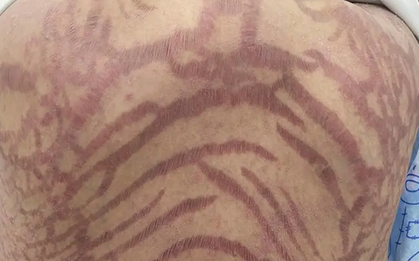 Da đầy vết rạn như da rắn vì thuốc mỡ bôi da mua trên mạng