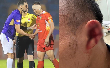 Trọng Hoàng bị Hoàng Hên giẫm rách tai ở V.League
