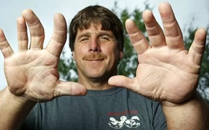 Người đàn ông sở hữu bàn tay to bất thường, sự thật phía sau khiến tất cả kinh ngạc