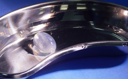 Đặt tinh hoàn nhân tạo cho chàng trai 20 tuổi