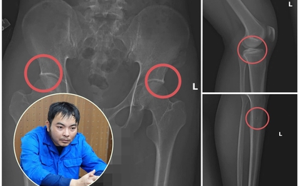 Nóng: Cựu cán bộ y tế cầm đầu đường dây tự đục vỡ xương khớp để lấy bảo hiểm