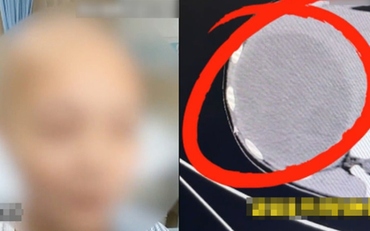 Bé gái 15 tuổi phát hiện khối u to bằng nửa lá gan, bác sĩ tức giận: Ai lại coi món này là bữa chính!