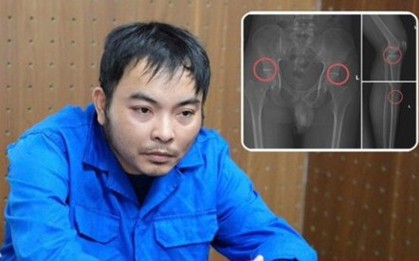 Cựu nhân viên y tế đục vỡ xương trục lợi bảo hiểm: Thủ đoạn tàn nhẫn, bất nhân