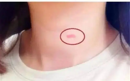 Thấy con gái 14 tuổi có "dấu vết lạ" trên cổ, hành động của người mẹ sau đó khiến dân mạng thán phục