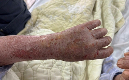 Người phụ nữ bị ngứa dữ dội đến mức “ảo giác có sâu bò”: Nguyên nhân gây sốc từ thói quen nhiều người Việt vẫn làm