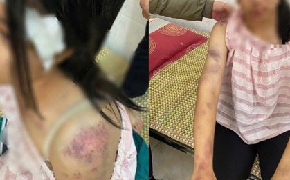 Bé gái bị người nhà đánh đập, tra tấn dã man vì nghi trộm tiền