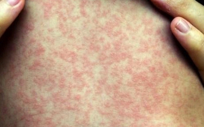 Dịch sởi bùng phát tại một xã