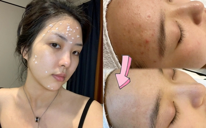 Tôi đã thắng "cuộc chiến" với mụn nhờ 4 sản phẩm bình dân