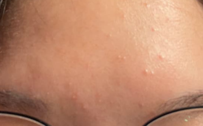 Con gái mọc mụn trứng cá, mẹ xin nghỉ phép đưa con đi cấp cứu