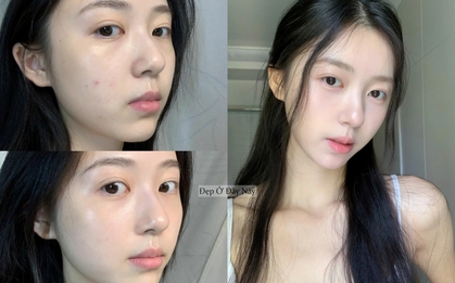 Từng bị mụn chi chít 2 bên má, cô nàng này đã áp dụng 4 bí quyết và làn da được cải thiện thấy rõ