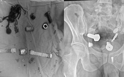 Người đàn ông liên tục đau bụng, bác sĩ sốc nặng khi phát hiện "bí mật" đáng sợ