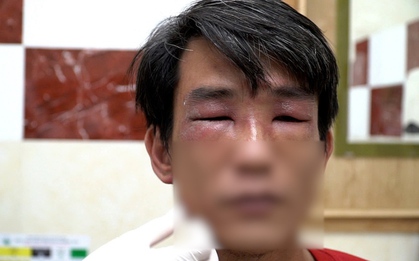 Kiến ba khoang lại tấn công người TP.HCM, bác sĩ cảnh báo chữa trị bằng 'mẹo'