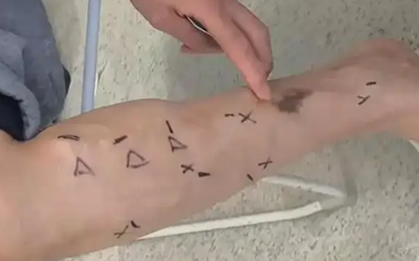 Đầu bếp 40 tuổi chân thâm đen gần như loét chỉ sau 1 năm vì thói quen nhiều người làm mỗi ngày