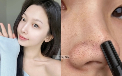 Ở tuổi 27, tôi học được cách làm sạch mụn đầu đen ở mũi hiệu quả, làm 1 lần là "nhẵn thín"