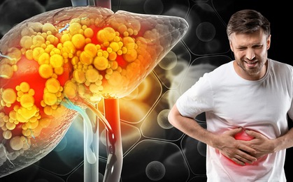 Nghiên cứu khoa học chỉ rõ 1 việc giúp đảo ngược tình trạng gan nhiễm mỡ: Muốn bảo vệ gan, hãy làm ngay