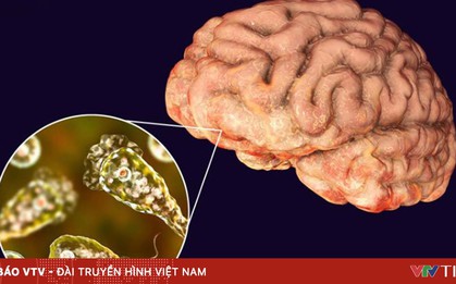 Ký sinh trùng - mối đe dọa thầm lặng gây viêm não, màng não ở trẻ em