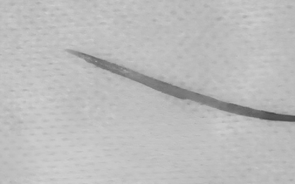 Người đàn ông 57 tuổi đau bụng thốc ngược lên, bác sĩ gắp ra thứ "đáng sợ" dài 5cm