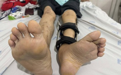 Người đàn ông bị bại liệt hơn 50 năm bỏ được chiếc giày đôn chân 6cm sau ca phẫu thuật