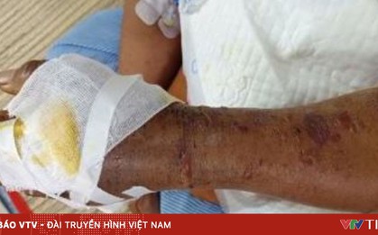 Cảnh báo nguy cơ rắn lục đuôi đỏ tấn công