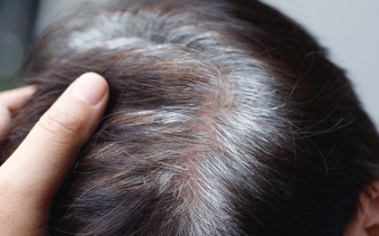 Bác sĩ nói gì về tin “tóc bạc nhiều là dấu hiệu ung thư”?