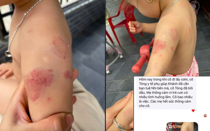 Bé hơn 2 tuổi có nhiều vết cắn, bầm tím: Giáo viên nói "quá nhiều việc", nhà trường báo "camera mất dữ liệu"