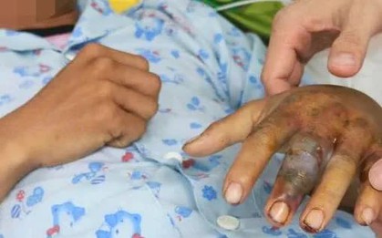 Rắn cắn nguy hiểm: Không đắp lá, không chữa mẹo