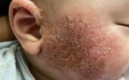 Cảnh báo các bệnh da liễu thường gặp khi thời tiết lạnh