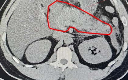 Viêm tụy cấp do tăng triglycerid máu: Bệnh lý nguy hiểm