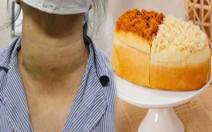 5 thực phẩm người có u tuyến giáp không nên ăn dù thèm đến mấy