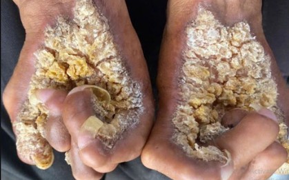 Da xù xì như mọc nấm vì hội chứng lạ