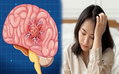 Đau đầu tưởng tiền đình nhưng có thể là 'chỉ điểm' của bệnh trọng