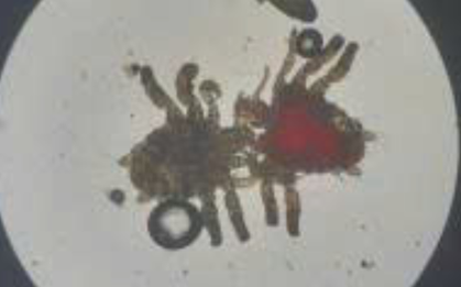 Ngứa dữ dội “vùng kín”, người đàn ông phát hiện điều không ngờ